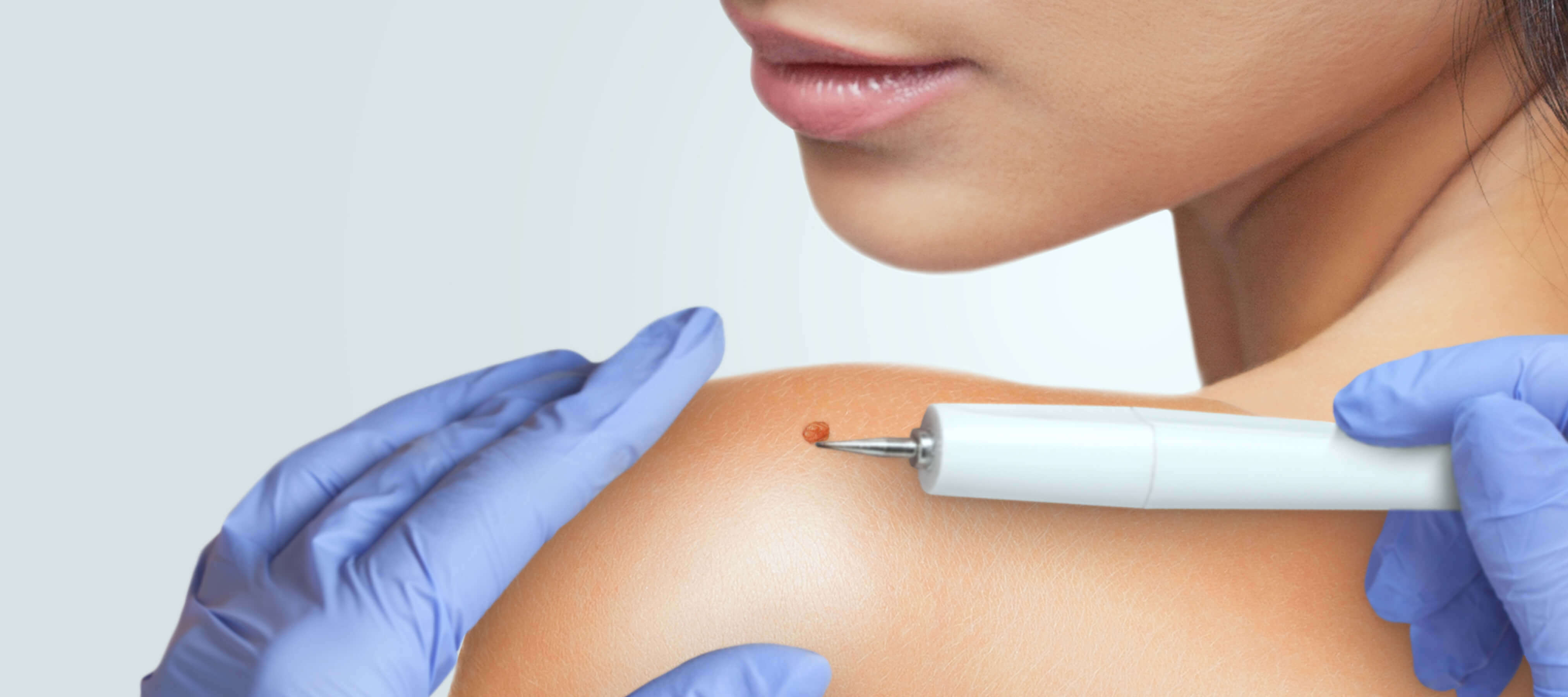 Et Beni Nedir? Neden Çıkar? Tedavi Yöntemleri Nelerdir? Dr. Ahmet Acar