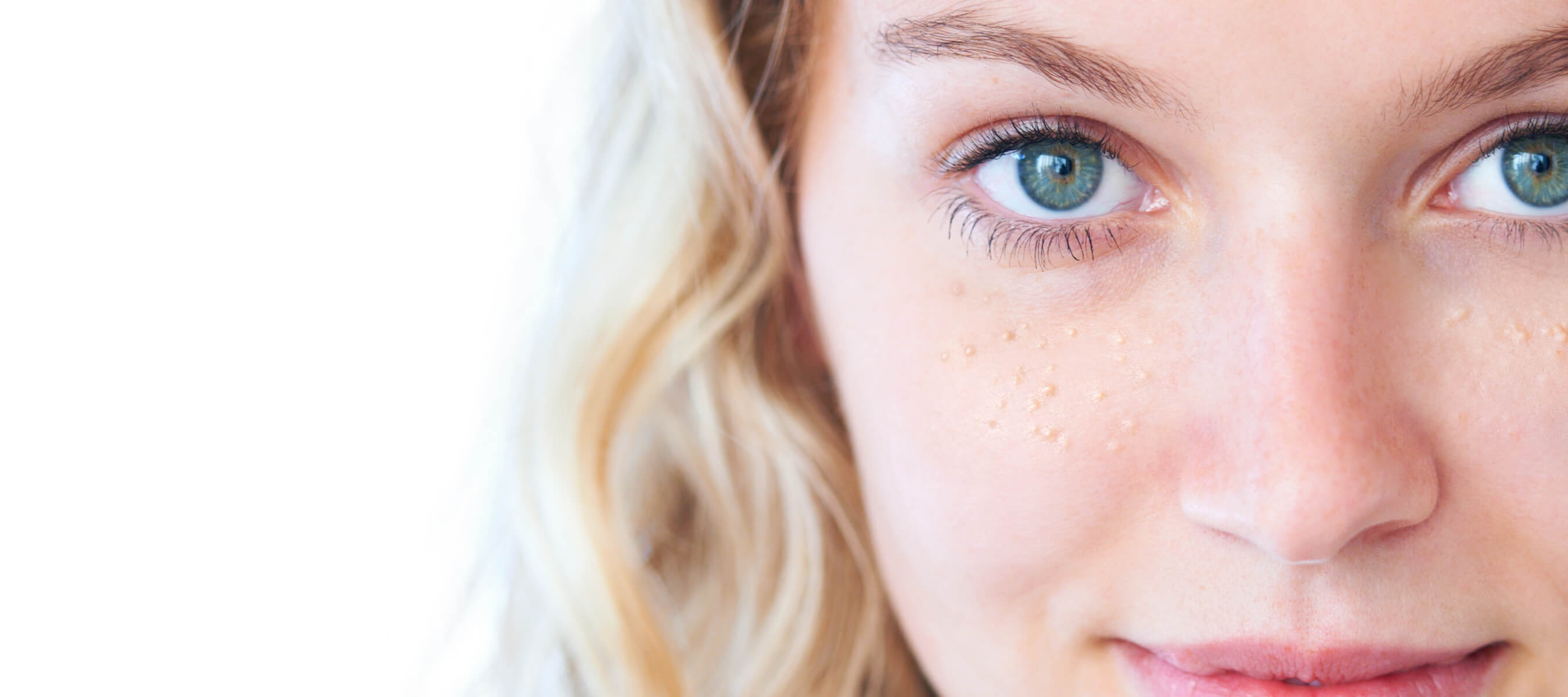 Milia Nedir? Yüzdeki Beyaz Noktalar ve Tedavisi Dr. Ahmet Acar